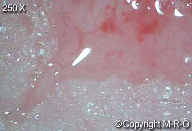 Morgellons-infection7.jpg (11096 Byte)