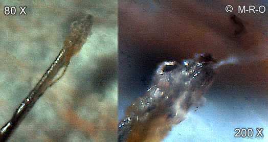 hair-root morgellons infestation