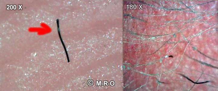 morgellons-hairs