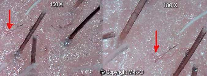 morgellons-infection