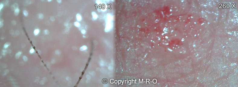 morgellons-infection8.jpg (21017 Byte)