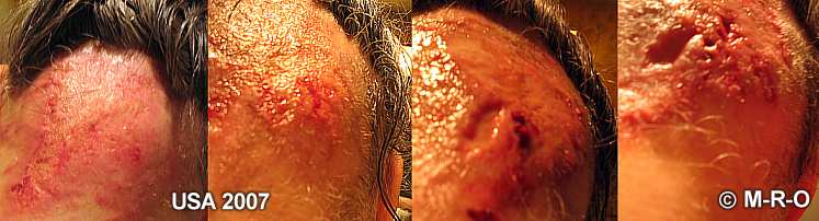 deep morgellons wounds