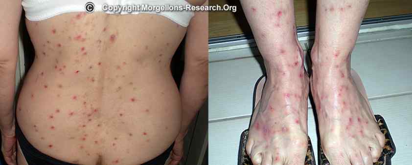 morgellons wounds all over the body
