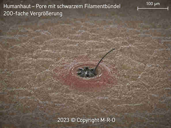 schwarzes Biofilmb&uuml;ndel in einer menschlichen Hautpore