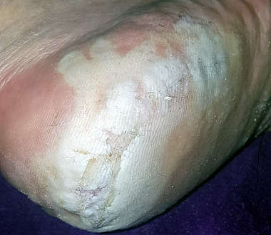 morgellons-foot-wounds