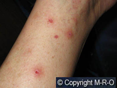 morgellons-reinfektion-über-kleidung