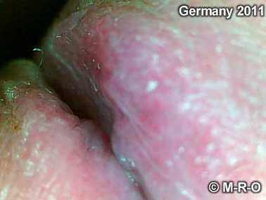 morgellons hautsymptome genitalien1