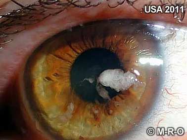Morgellons Augenperforierender Biofilm