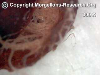 Morgellons Fasern Agrobakterium